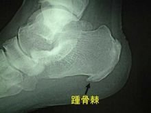足跟骨质增生