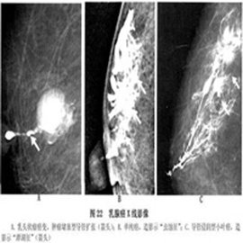 乳腺导管内原位癌