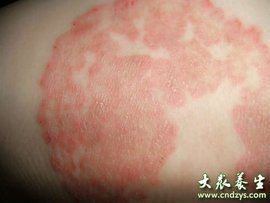 过敏性湿疹治疗