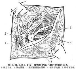 胸锁乳突肌下端切断术emmet教程图片