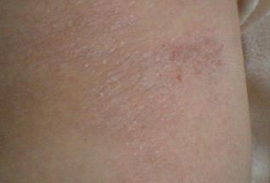 小儿季节性皮炎