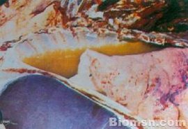 急性渗出性胸膜炎