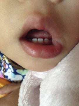 小儿疱疹性咽颊炎