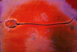 人类精液过敏症,