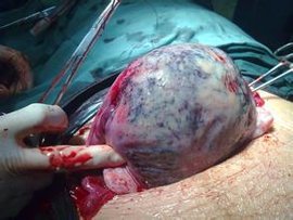 子宫胎盘卒中_360百科