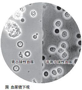 肾结石血尿会自愈吗 肾性血尿有自愈的吗?-百