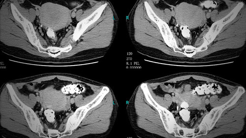 子宫畸形_360百科