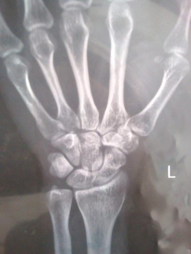 骨科大夫看看周壮骨折,恢复的如何了。一周了