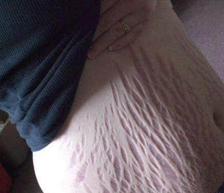 一般多少周开始长妊娠纹 t01d3a2d1de2b76d7e6.jpg?size=437x376