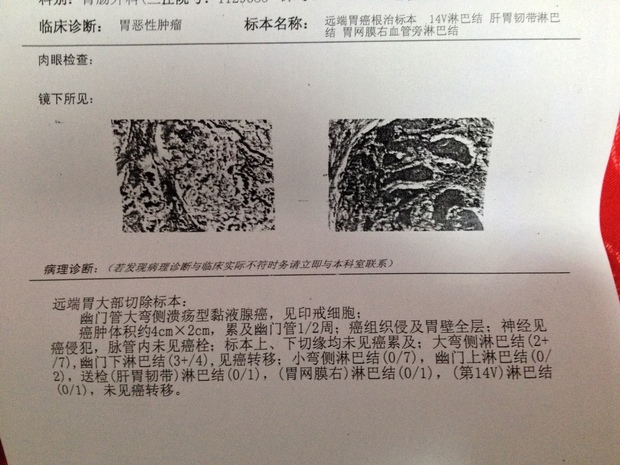 答:建议:胃癌的治疗与其他恶性肿瘤的治疗相同,均应将手术治疗作为