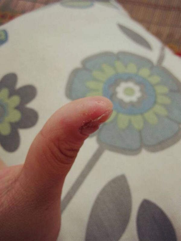 最近一段时间大拇指上开始有一些小水痘,并且